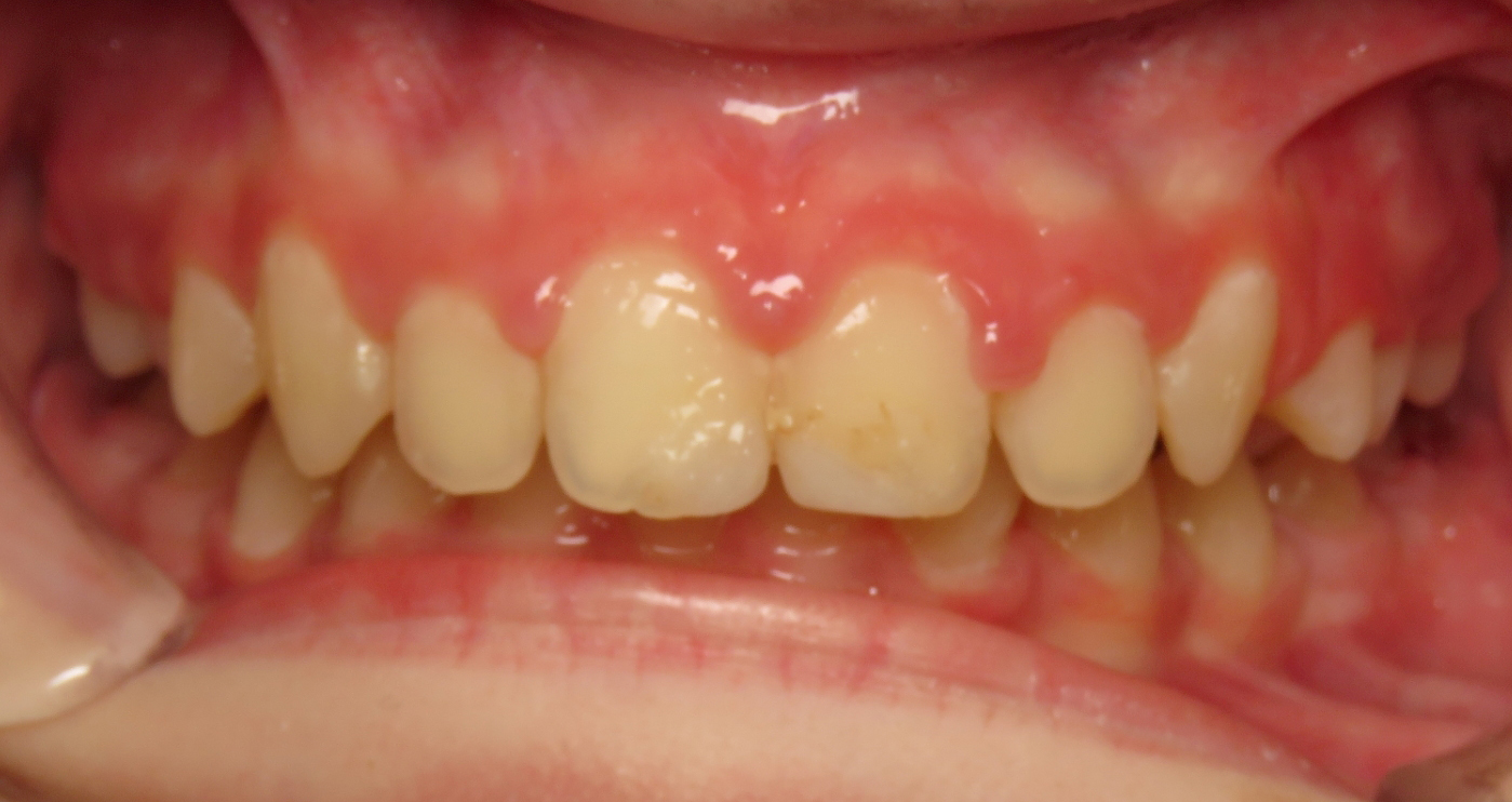 After treatment