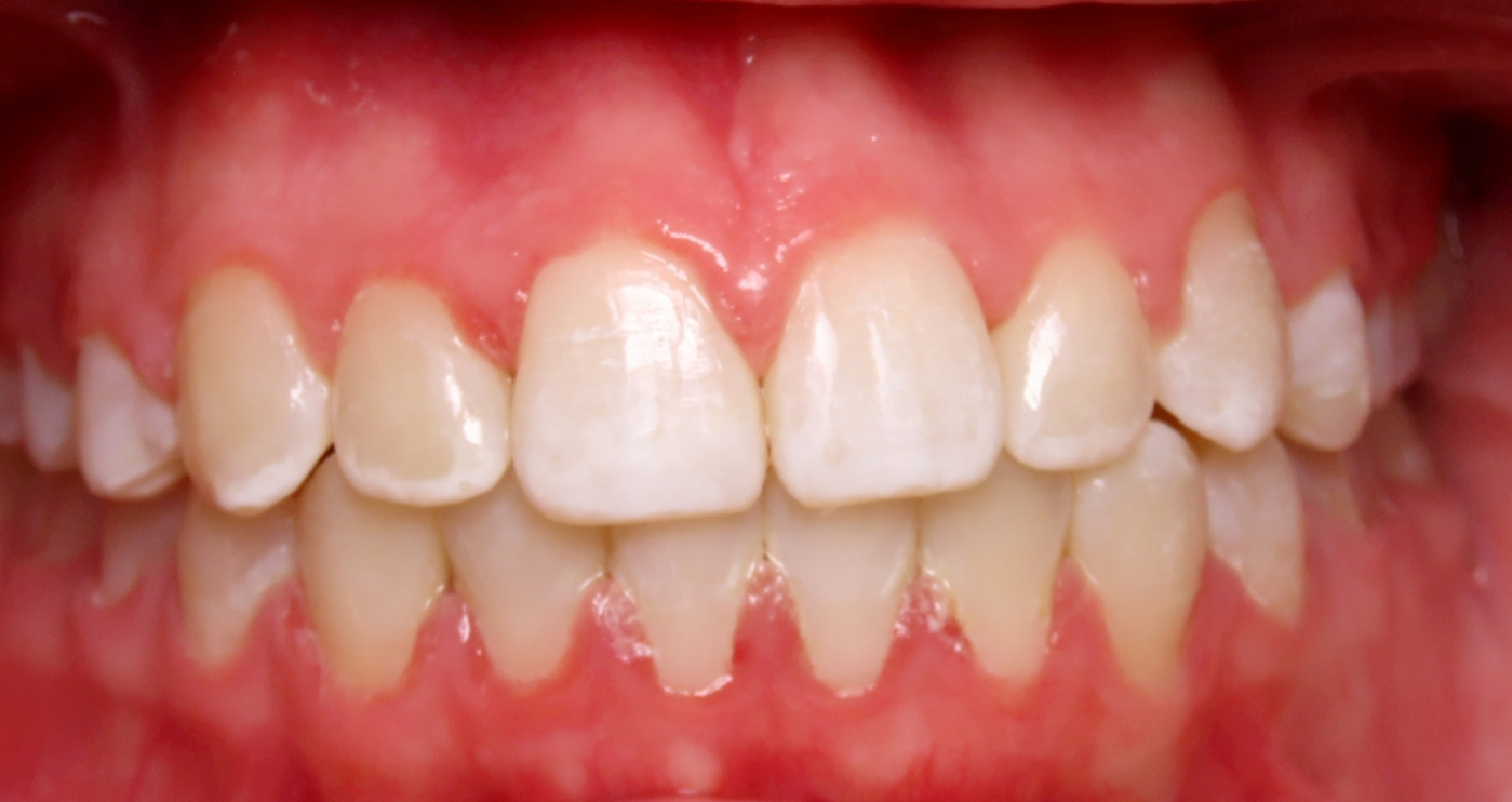 After orthodontic treatment at Lazin Family Orthodontics — patient 2