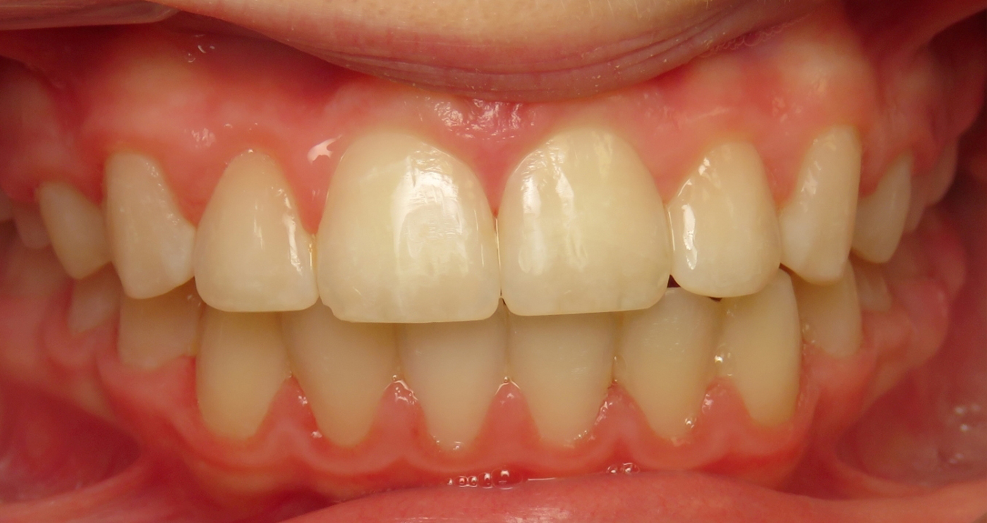 After orthodontic treatment at Lazin Family Orthodontics — patient 3