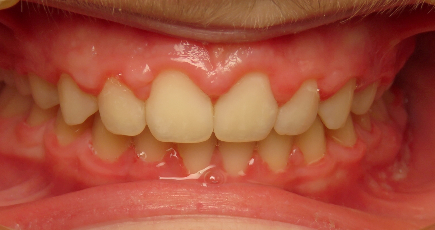 After orthodontic treatment at Lazin Family Orthodontics — patient 4