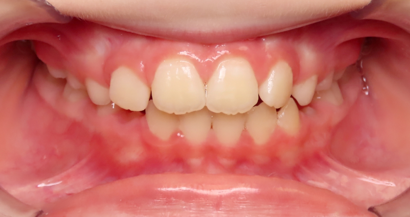 After orthodontic treatment at Lazin Family Orthodontics — patient 5