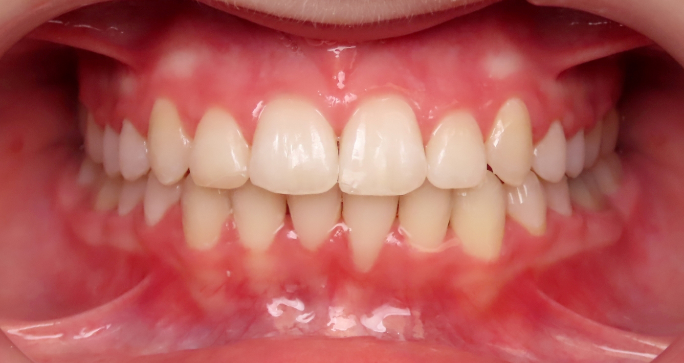 After orthodontic treatment at Lazin Family Orthodontics — patient 6