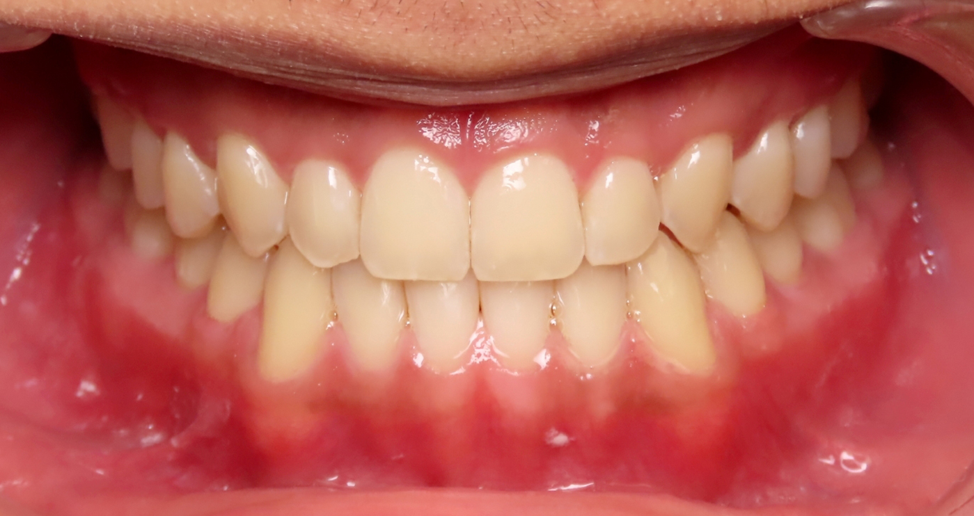 After orthodontic treatment at Lazin Family Orthodontics — patient 7