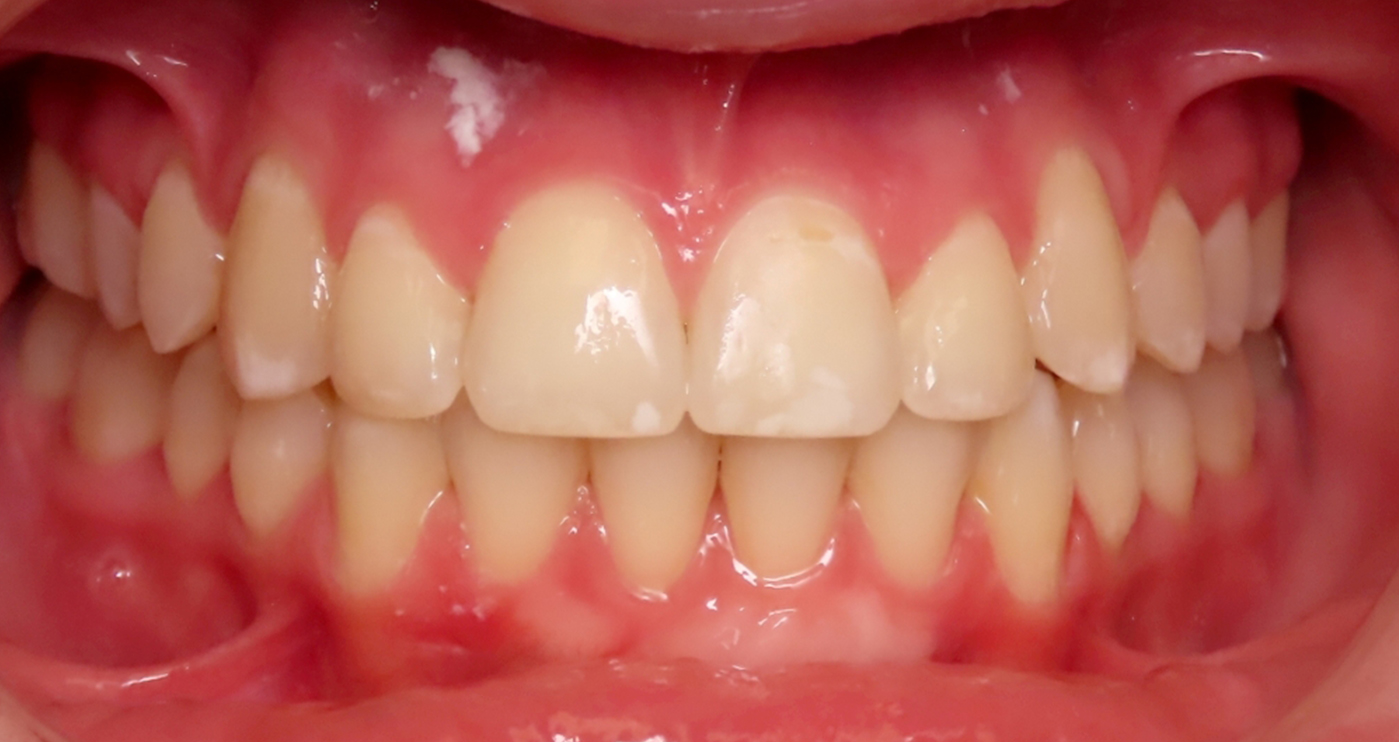 After orthodontic treatment at Lazin Family Orthodontics — patient 8