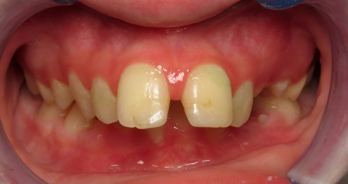 Before treatment