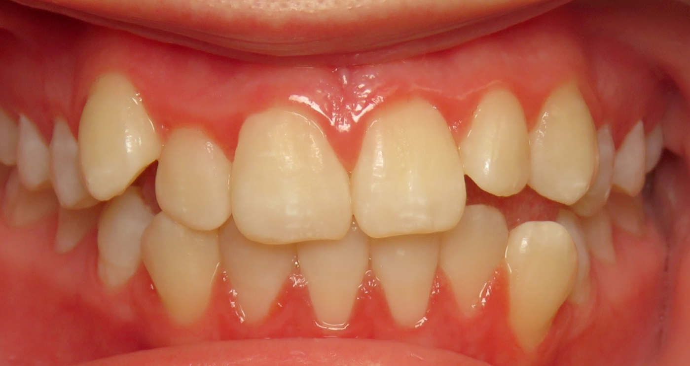 Before orthodontic treatment at Lazin Family Orthodontics — patient 2