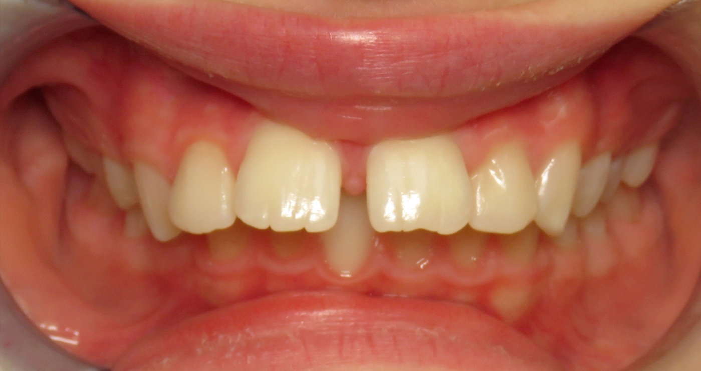 Before orthodontic treatment at Lazin Family Orthodontics — patient 3