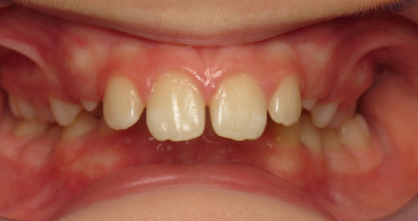Before orthodontic treatment at Lazin Family Orthodontics — patient 4
