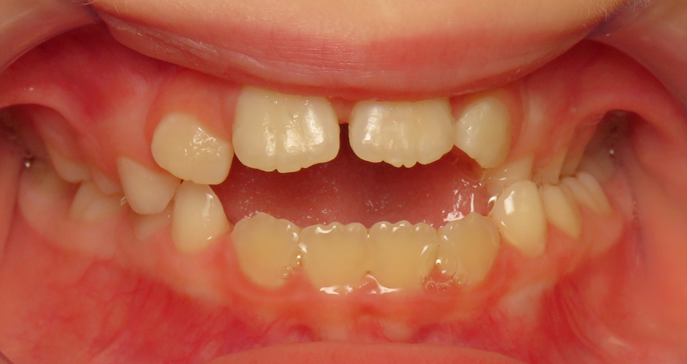 Before orthodontic treatment at Lazin Family Orthodontics — patient 5