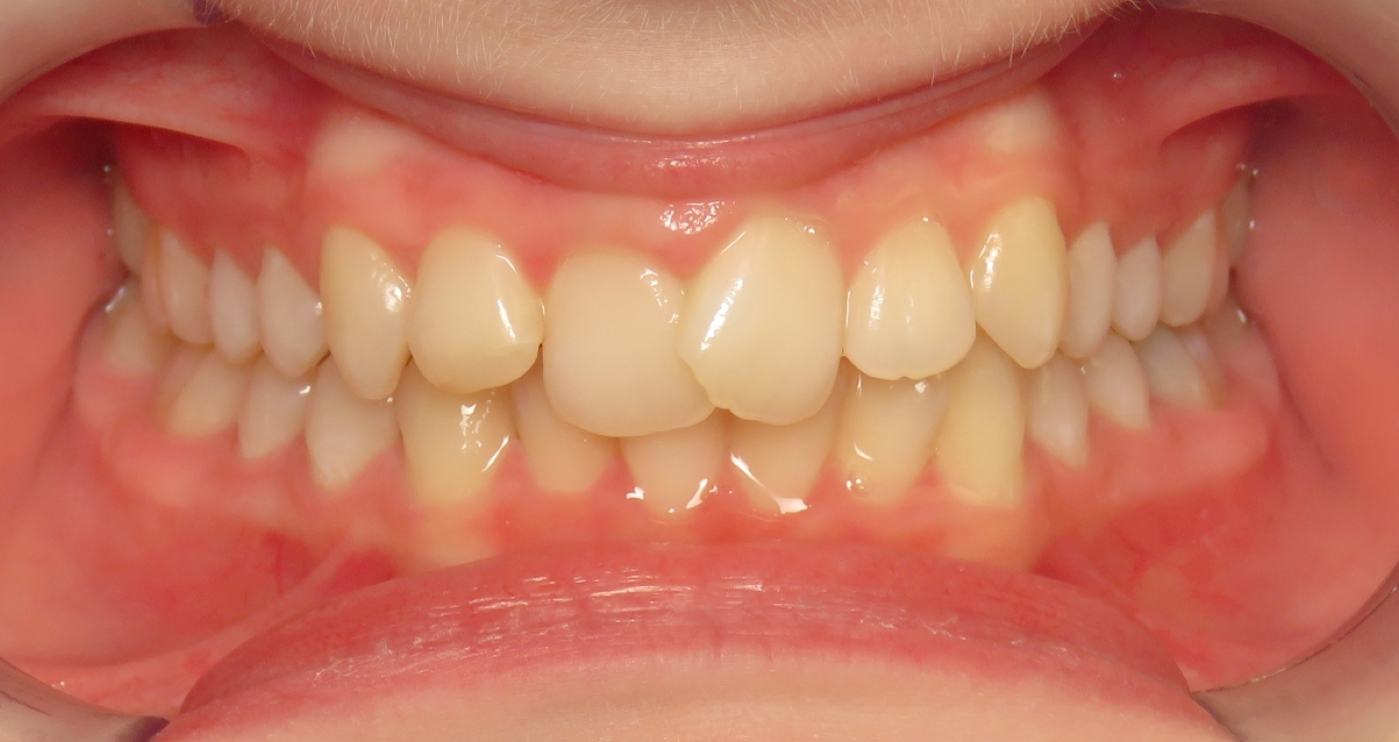 Before orthodontic treatment at Lazin Family Orthodontics — patient 6