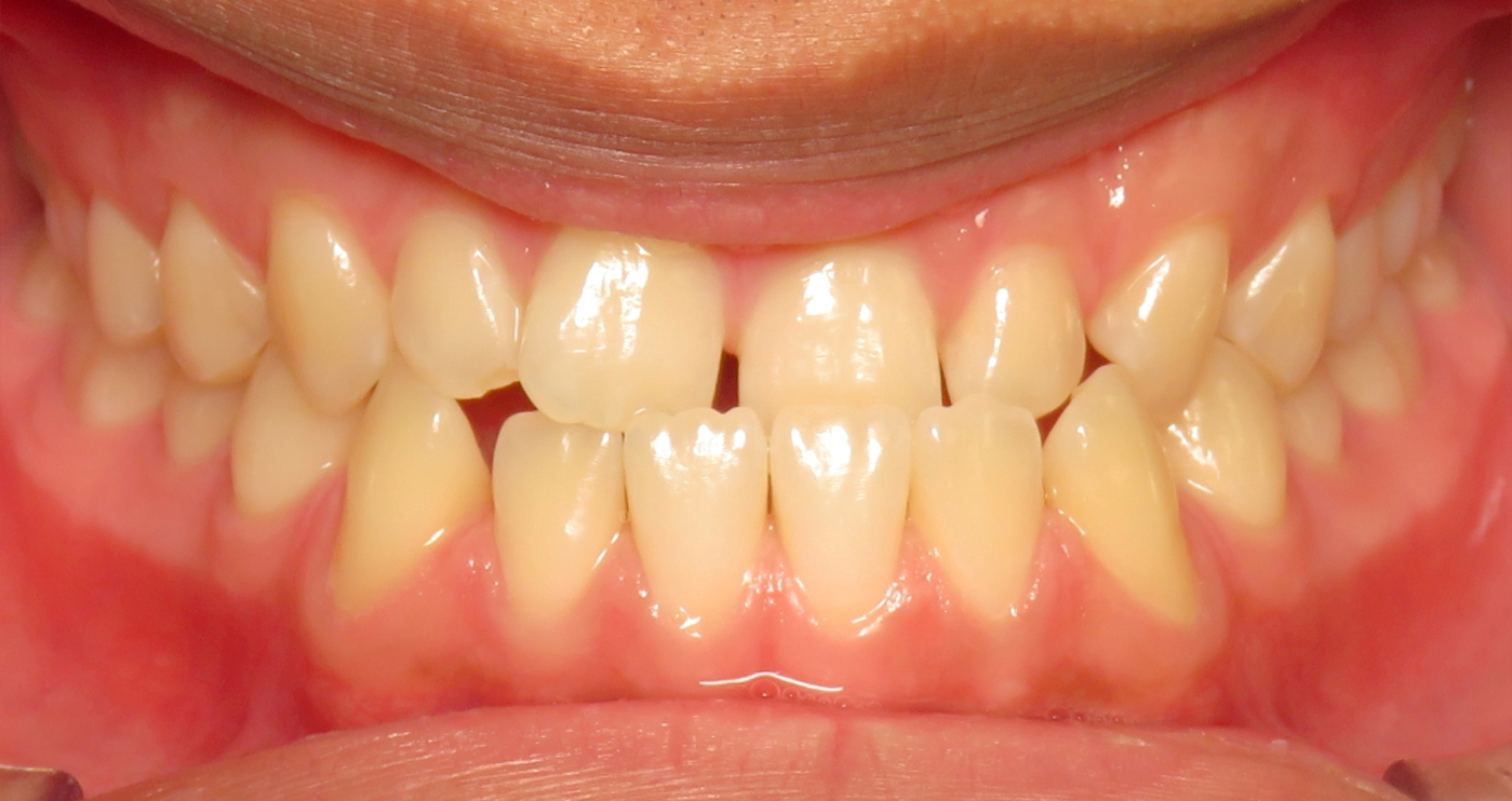 Before orthodontic treatment at Lazin Family Orthodontics — patient 7