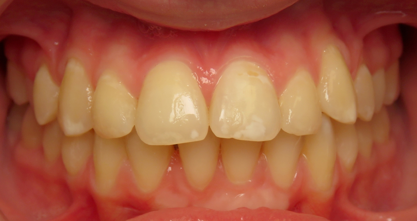 Before orthodontic treatment at Lazin Family Orthodontics — patient 8